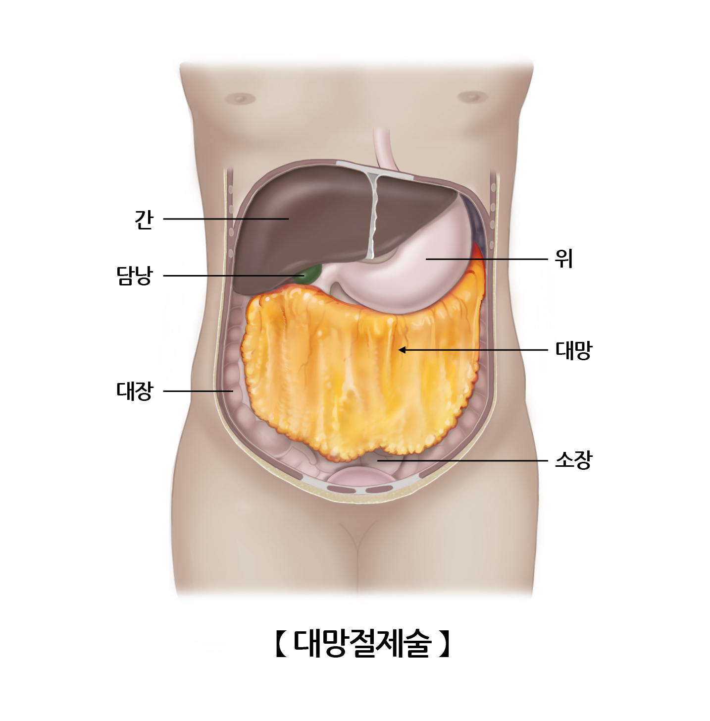 대망절제술