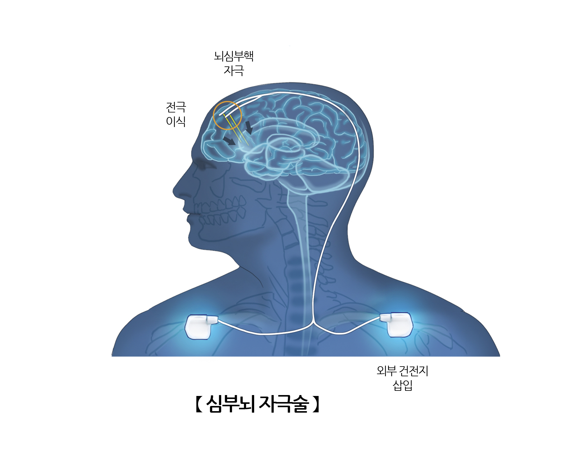 뇌심부 자극수술