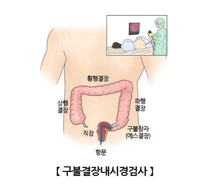 구불결장내시경검사