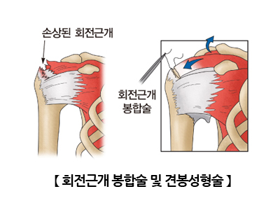 회전근개 봉합 수술 및 견봉 성형 수술