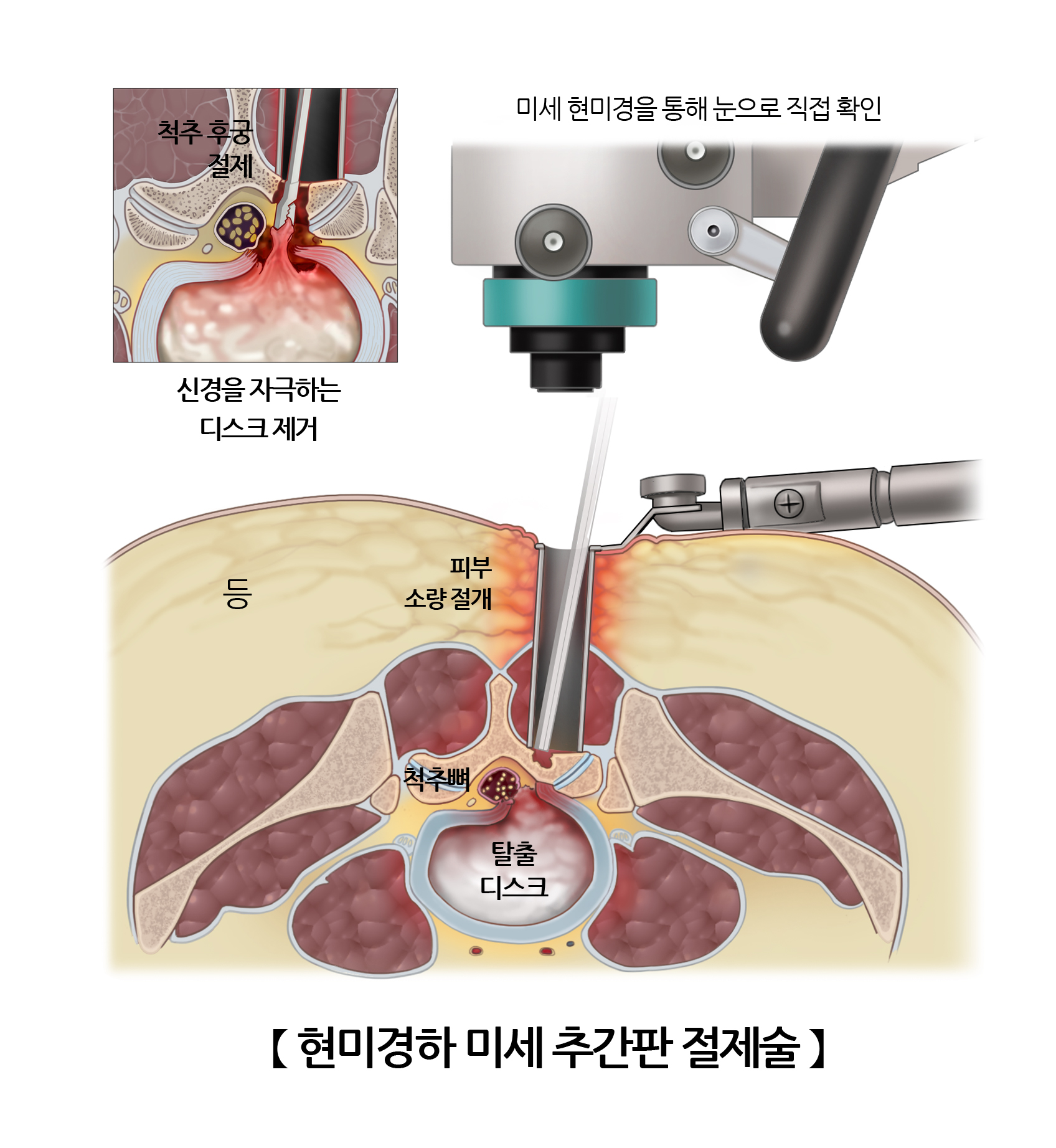 현미경하 미세 추간판 절제 수술