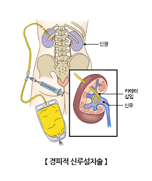 경피적 신루설치술