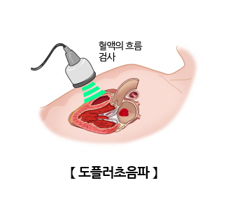 도플러초음파