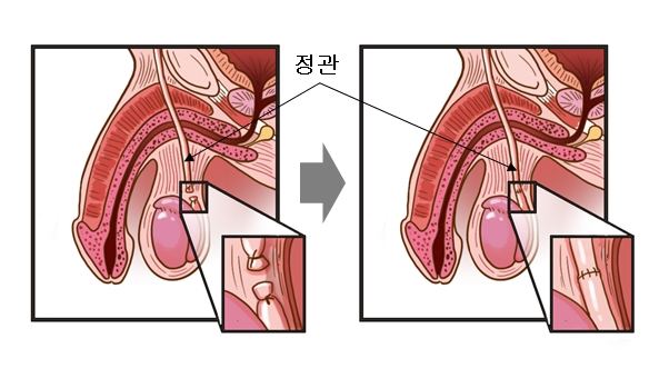 정관 복원술