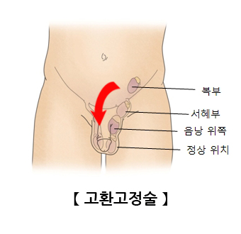 고환고정술