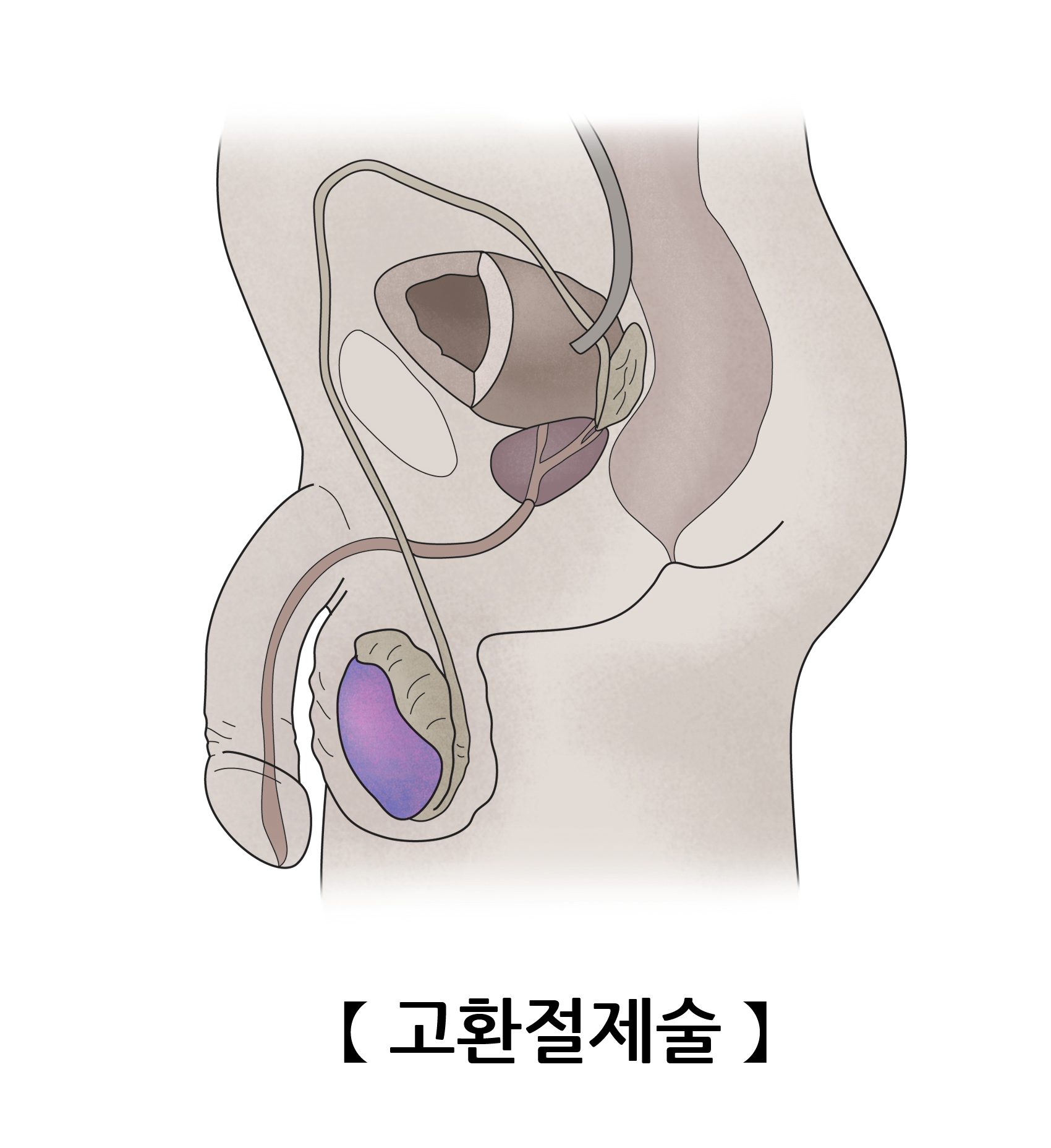 고환절제술