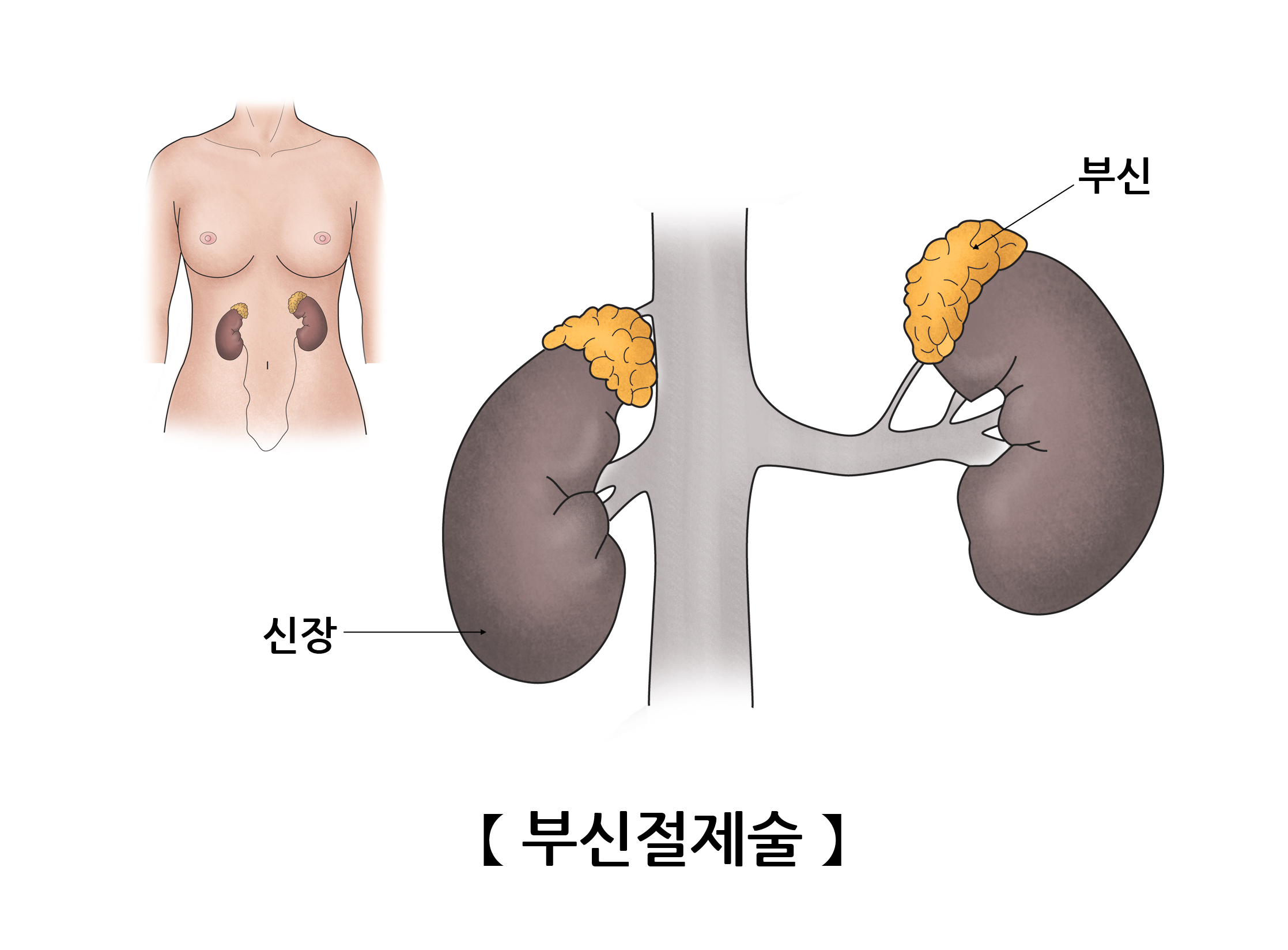 부신절제술