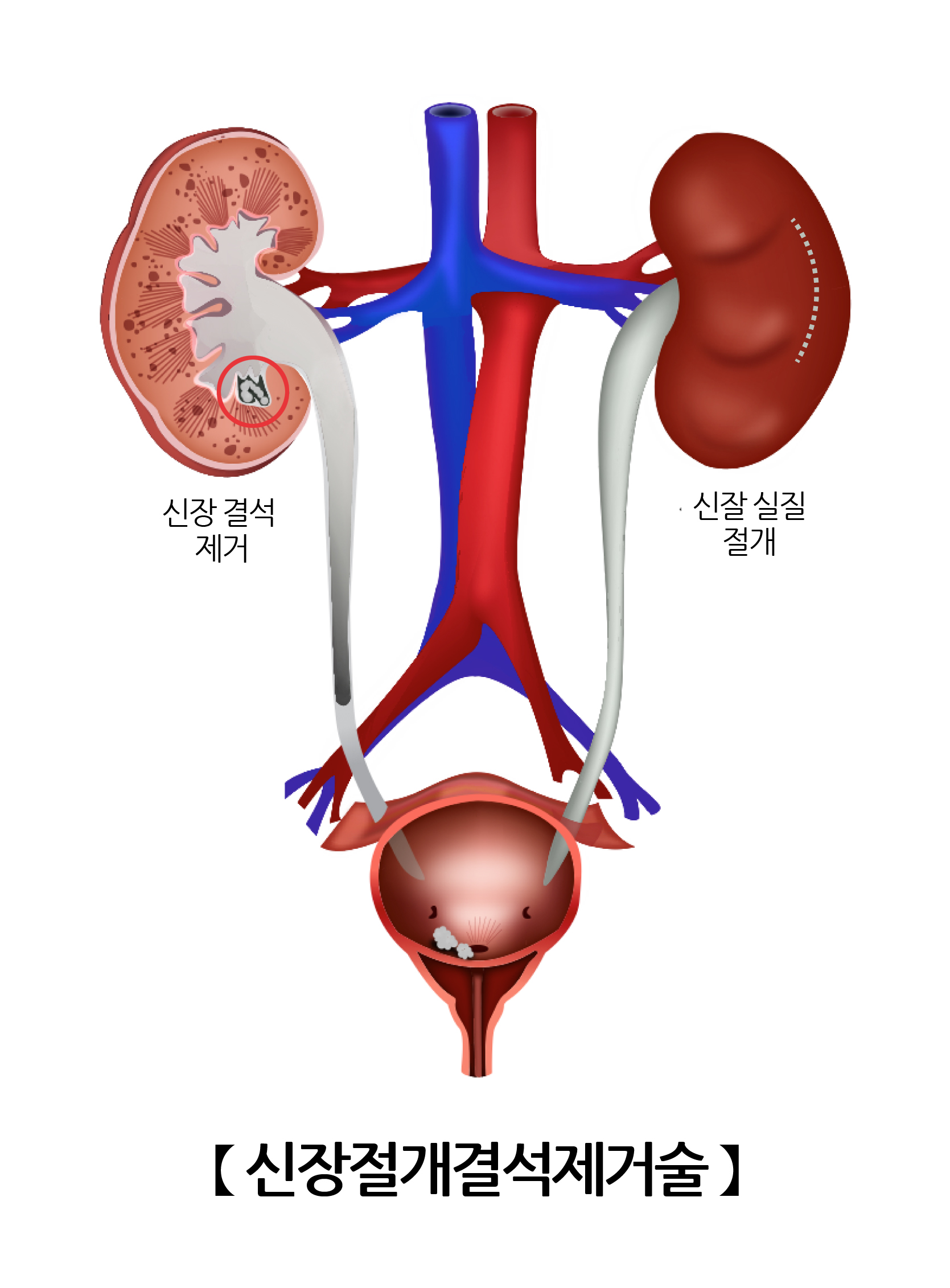 신장절개결석제거술