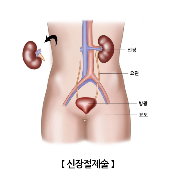 신장절제술