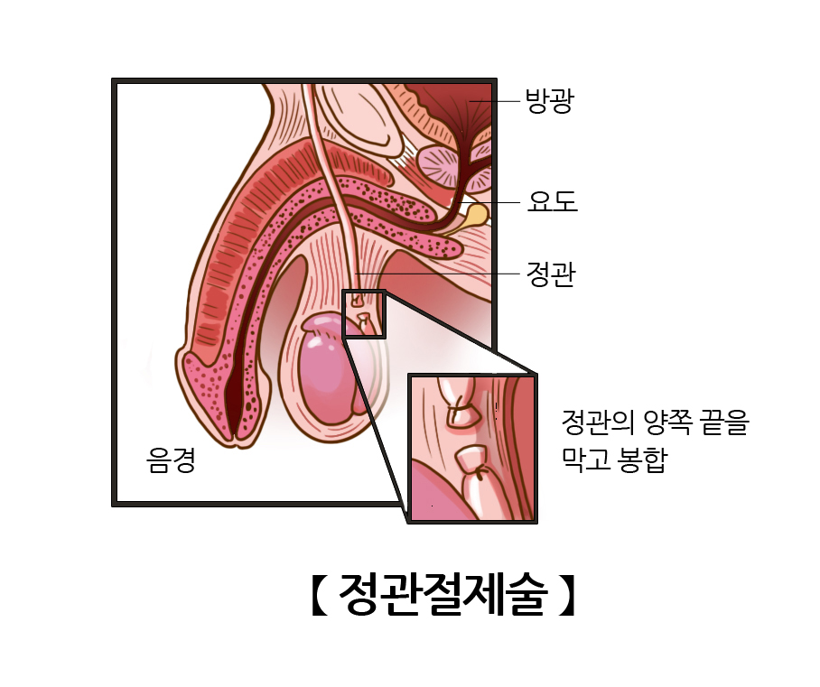 정관절제술