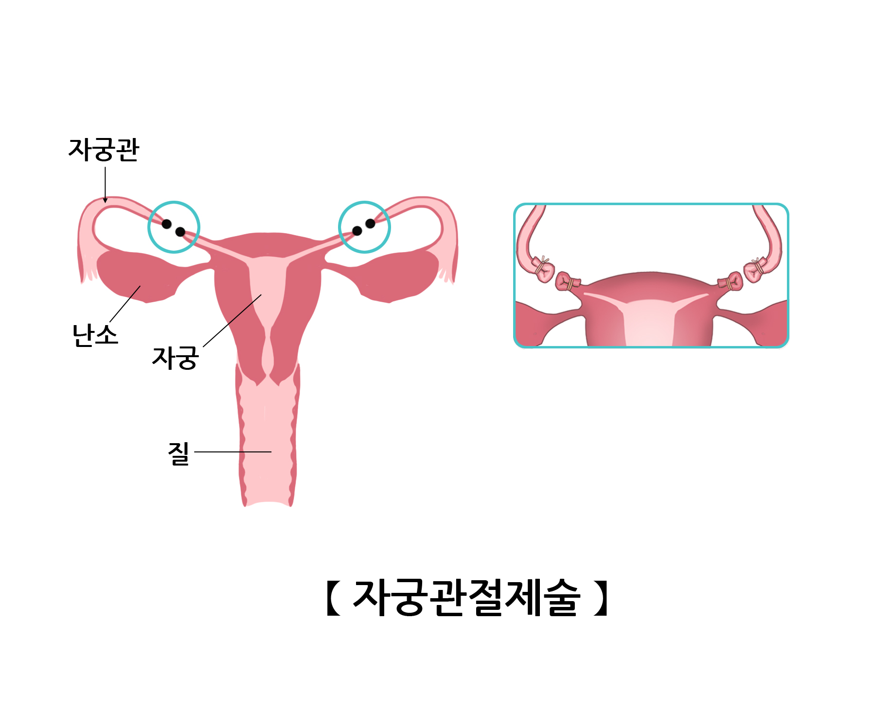 자궁관절제술