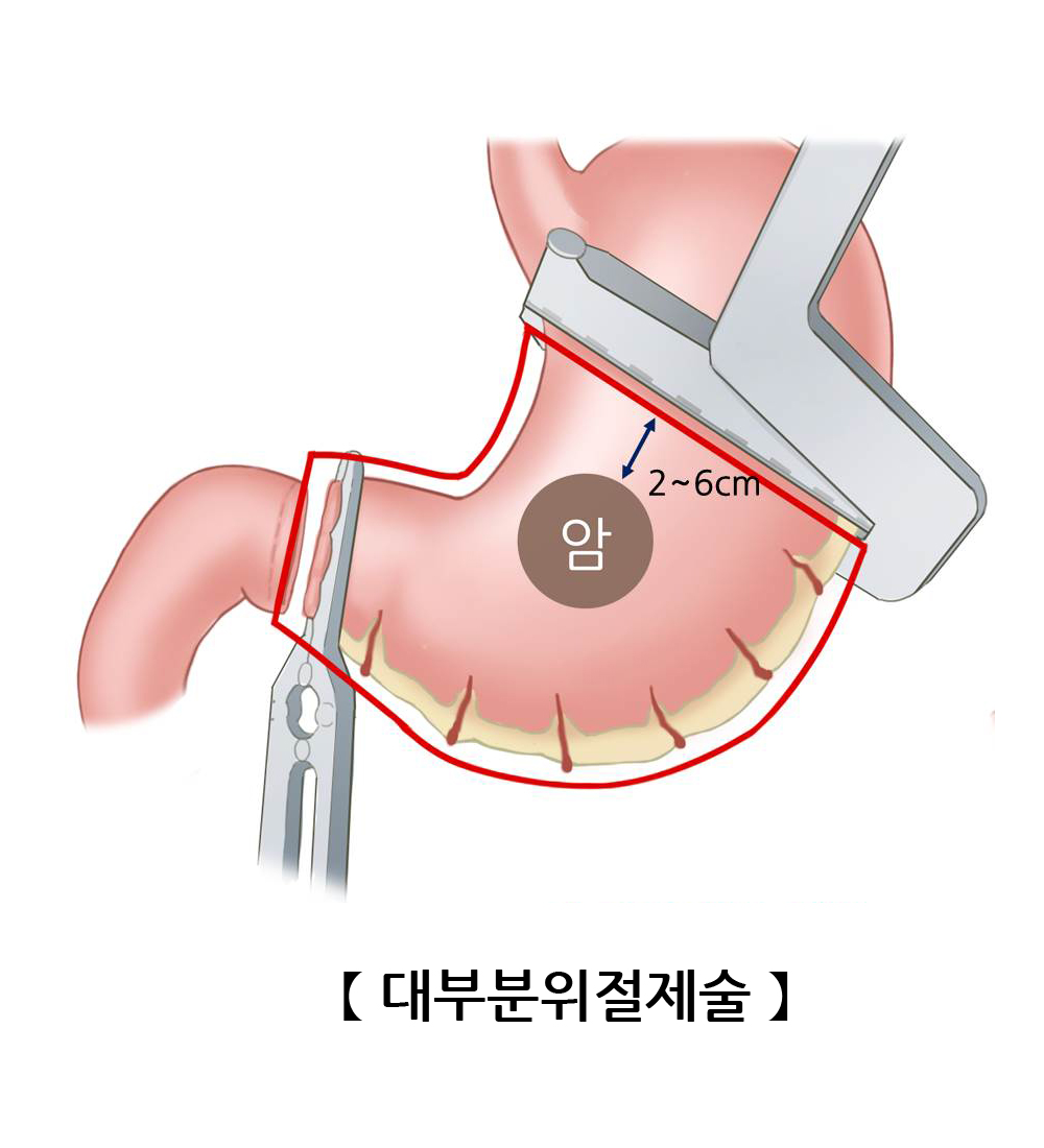 대부분위절제술