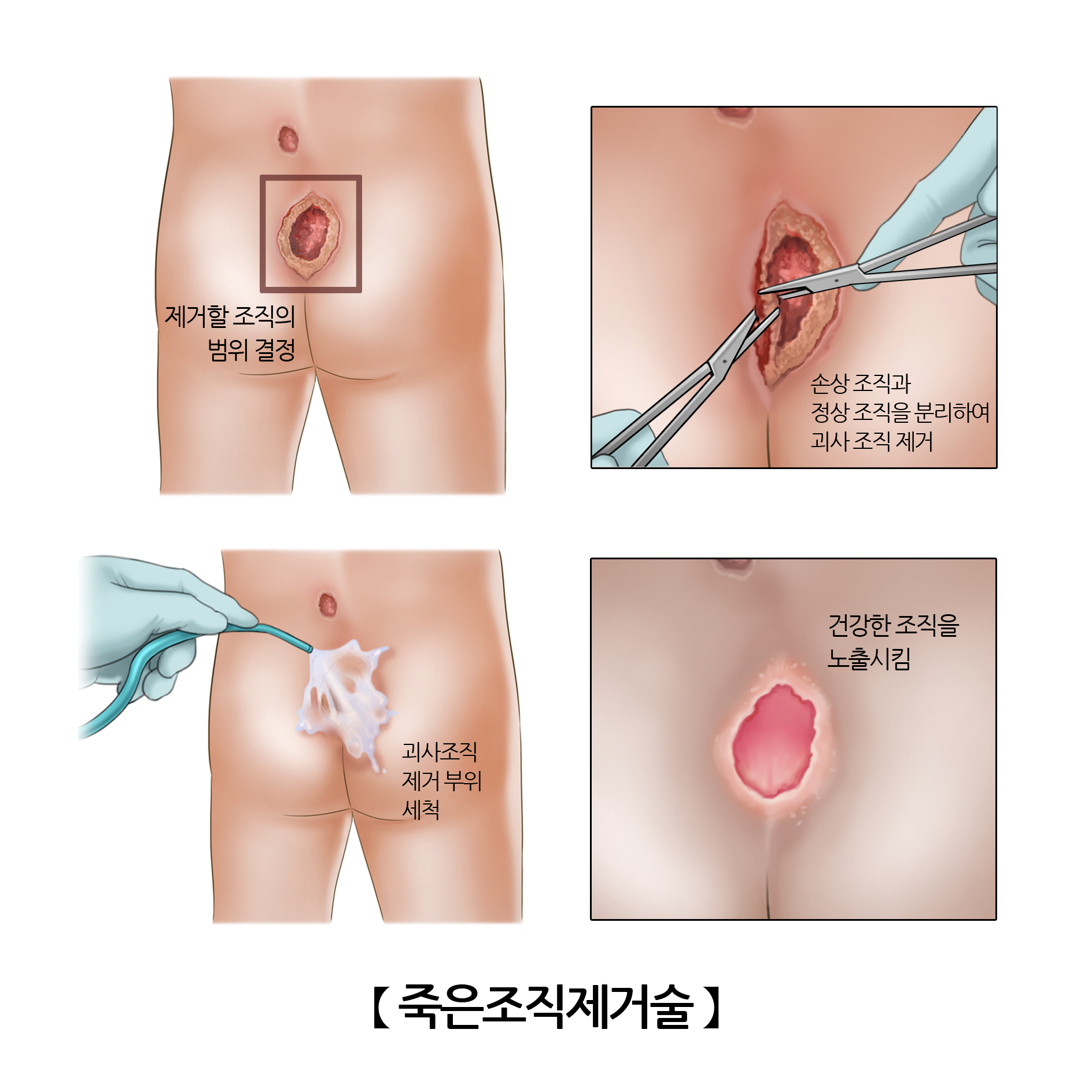 죽은조직제거술