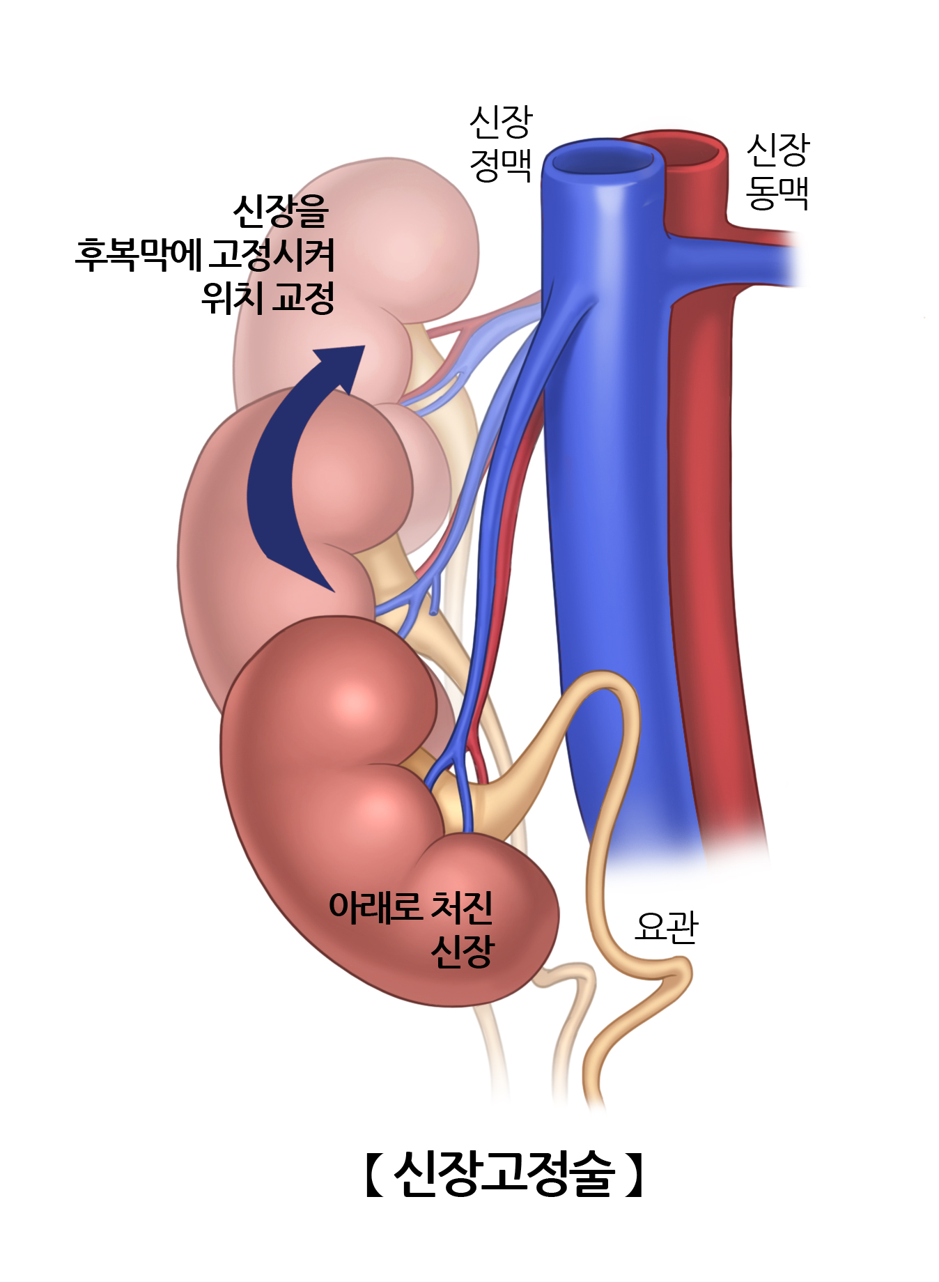 신장고정술