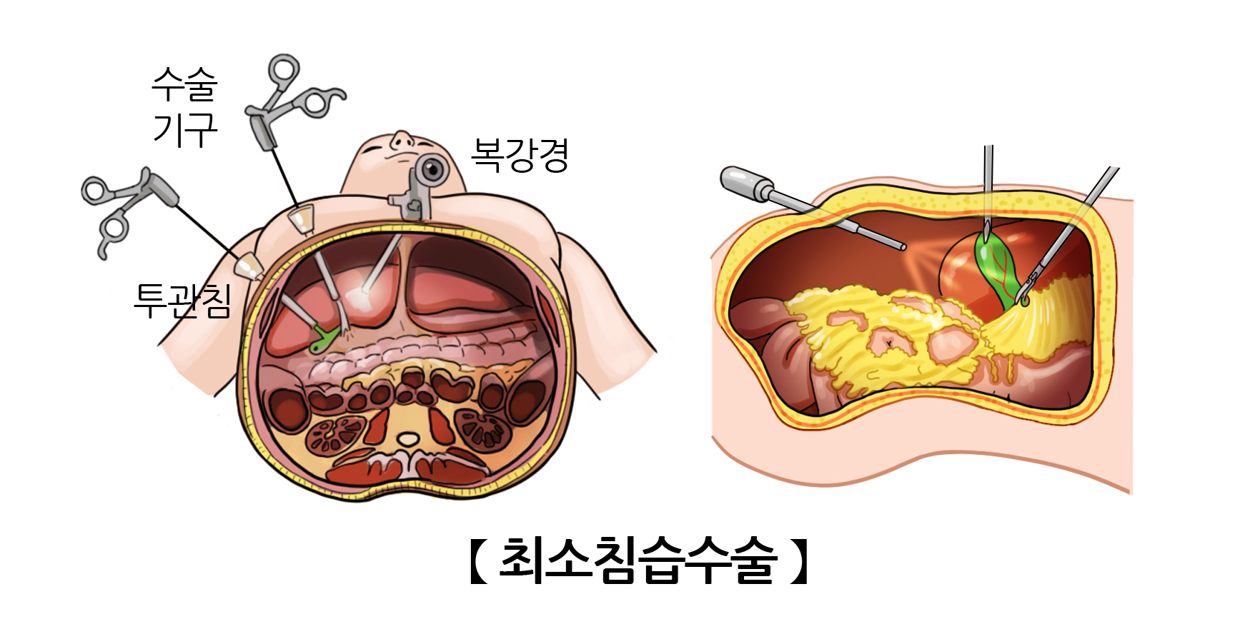 최소침습수술