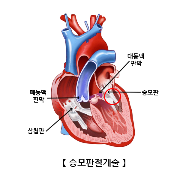 승모판절개술