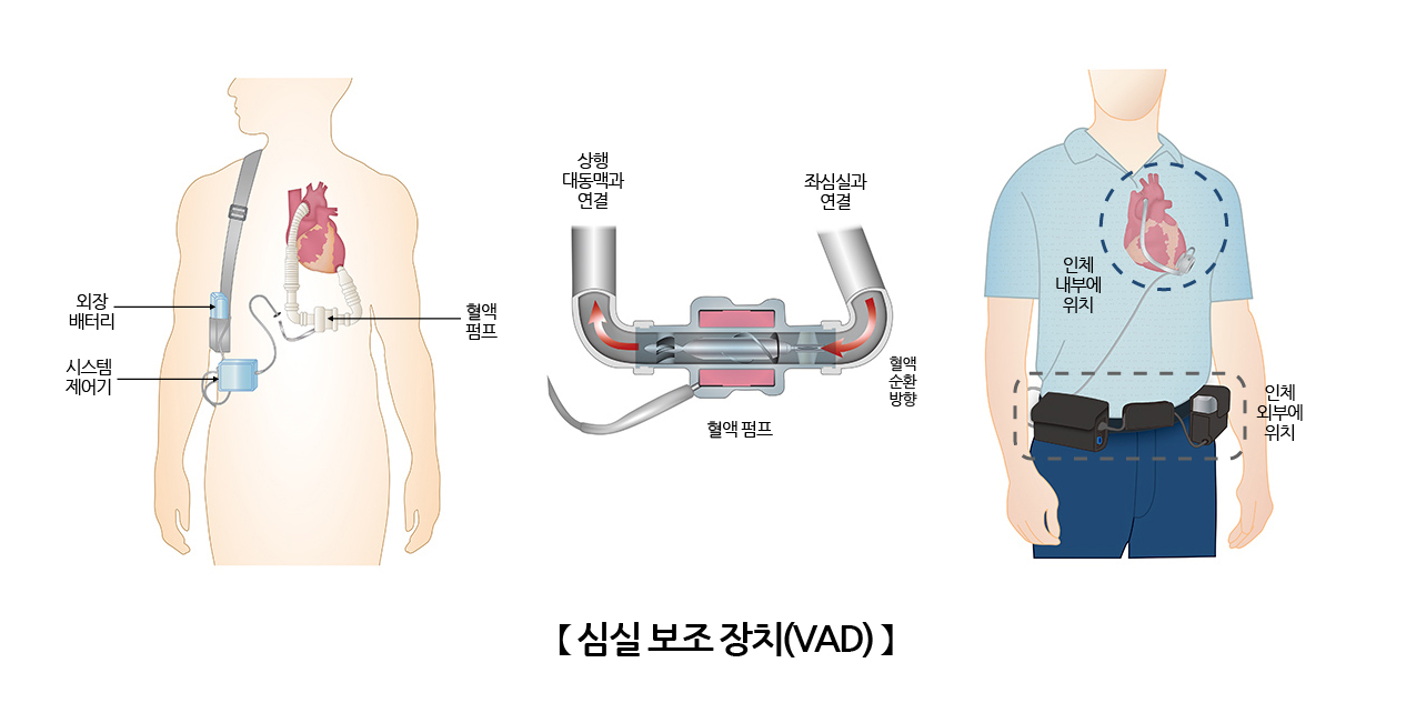 심실 보조 장치