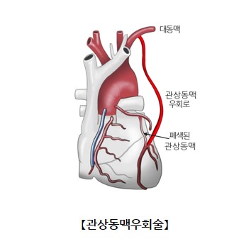 심장동맥우회로조성술