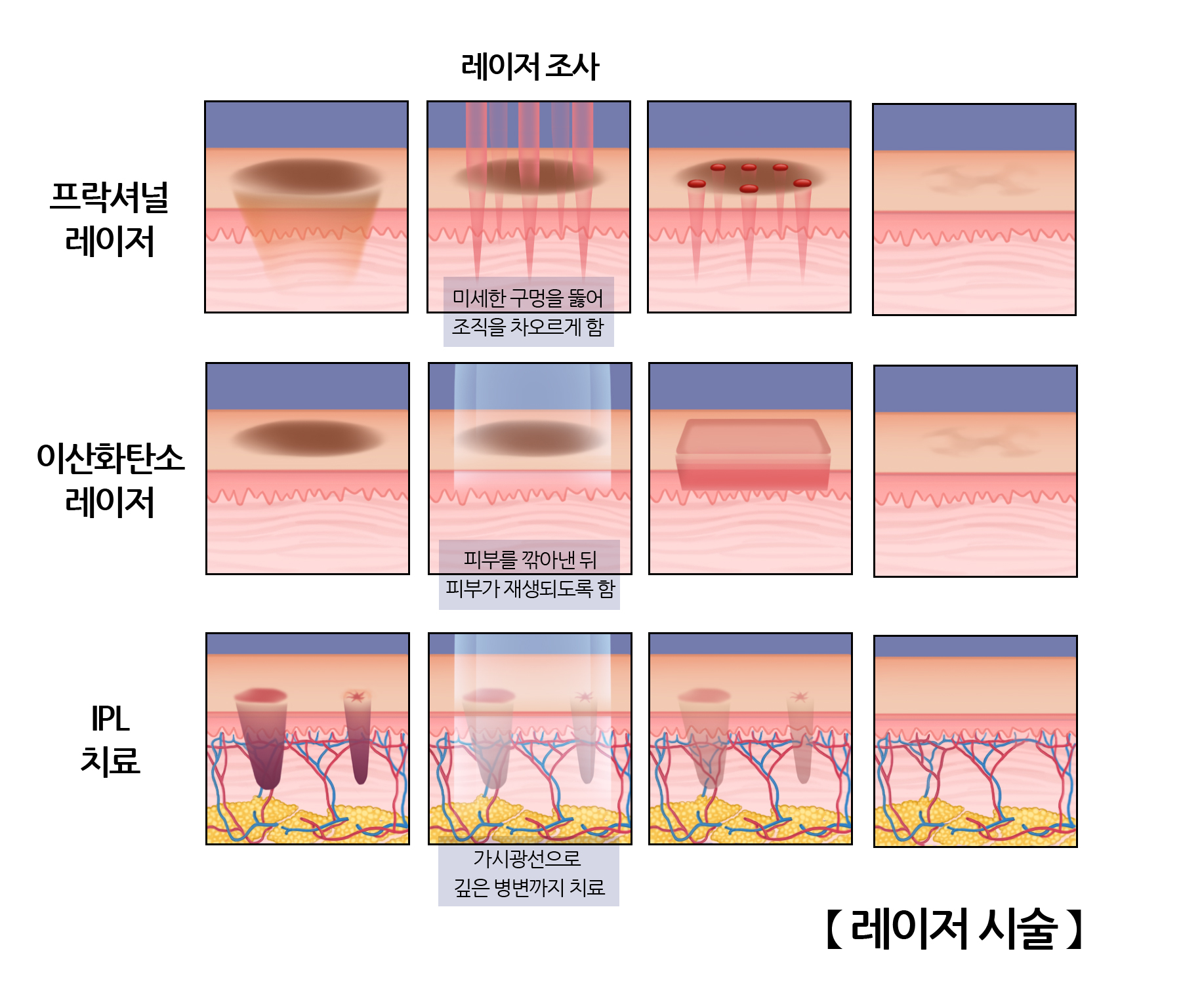 레이저 시술