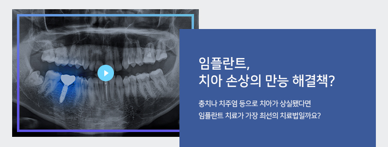 임플란트, 치아 손상의 만능 해결책?