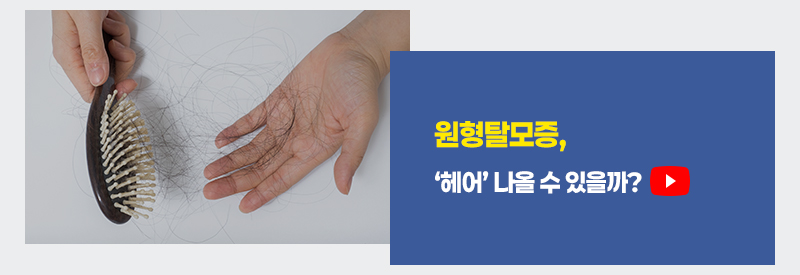 원형탈모증, '헤어' 나올 수 있을까?