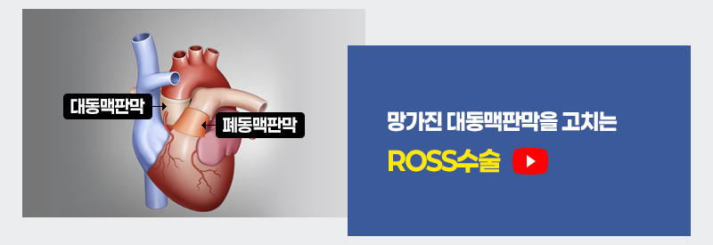 망가진 대동맥판막을 고치는 ROSS수술