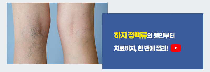 하지 정맥류의 원인부터 치료까지, 한 번에 정리!