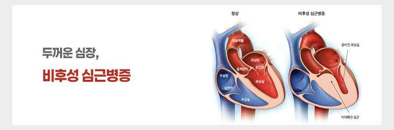 두꺼운 심장, 비후성 심근병증