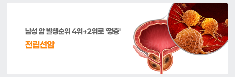 남성 암 발생순위 4위→2위로 '껑충' 전립선암