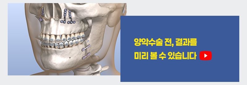 양악수술 전, 결과를 미리 볼 수 있습니다
