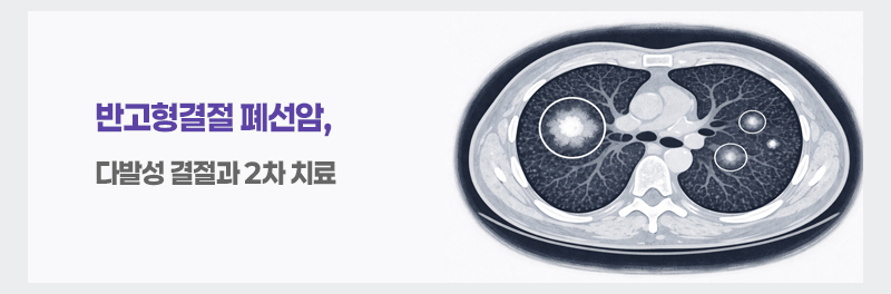 반고형결절 폐선암, 다발성 결절과 2차 치료