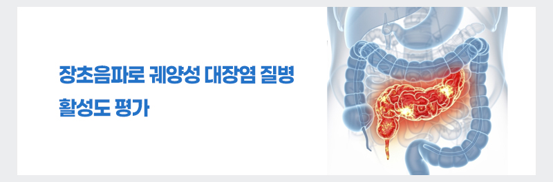 장초음파로 궤양성 대장염 질병 활성도 평가