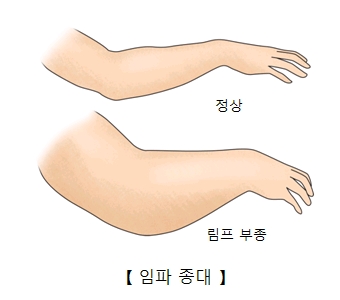 림프신티그래피(Lymphoscintigraphy) | 검사/시술/수술정보 | 의료정보 | 건강정보 | 서울아산병원