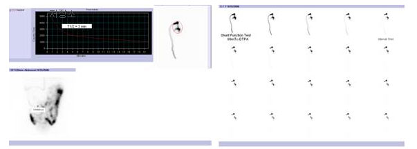 저장소에 주사한 99mTc-DTPA 약물이 뇌실과 복강 내로 잘 소통되는 영상 사진 예시