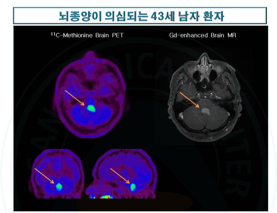 뇌종양을 11C Methionoine PET에서 확인한 43세 남자환자의 진료 자료 사진 예시