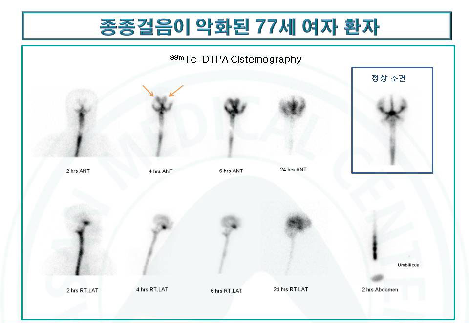 종종걸음이 악화된 77세 여자환자의 99mTc-DTPA뇌조조영술을 통한 수두증의 감별 진단 사진 예시