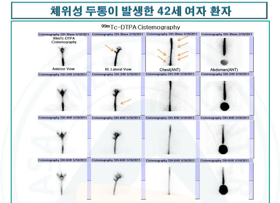 자발성두개내저혈압을 99mTc-DTPA뇌조조영술로 진단하고 누출부위를 확인한 42세 여자환자의 진료사진 예시