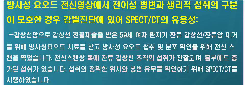 갑상선암으로 갑상선 전절제술을 받은 59세 여자 환자가 잔류 갑상선/잔류암 제거를 위해 방사성요오드 치료를 받고 방사성 요오드 섭취 및 분포 확인을 위해 전신 스캔을 찍었습니다.전신 스캔상 목에 잔류 갑상선 조직의 섭취가 관찰되며, 흉부에도 증가된 섭취가 있습니다. 섭취의 정확한 위취와 병변 유무를 확인하기 위해 SPECT/CT를 시행하였습니다.