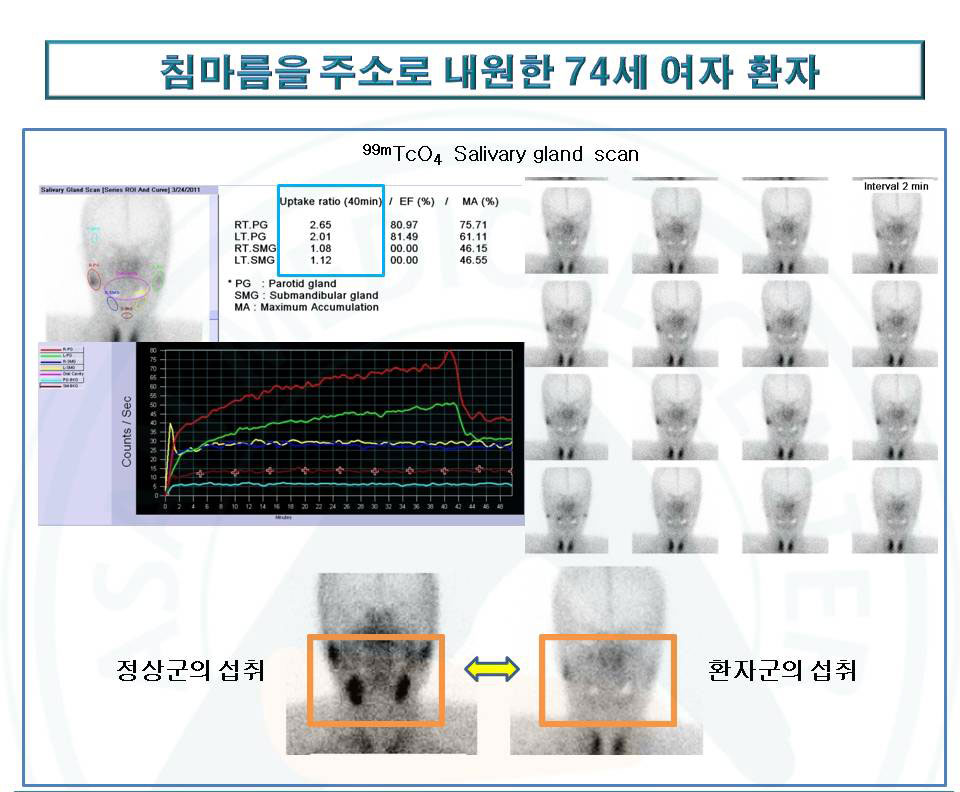 침마름을 주소로 내원한 74세여자환자의 침샘스캔에서 쇼그렌 증후군 소견을 보이는 진료사진 예시