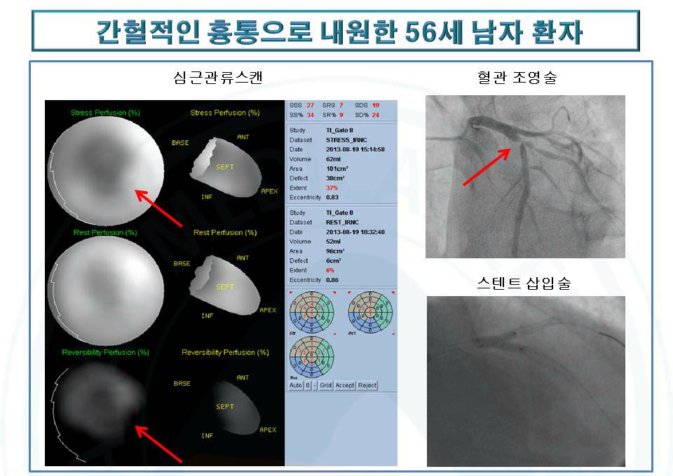 간혈적인 흉통으로 내원한 56세남자환자를 심근관류스캔을 통해 허혈성관상동맥 질환을 발견한 사례 사진 예시및 혈관조영술과 스텐트 삽입술 사진 예시