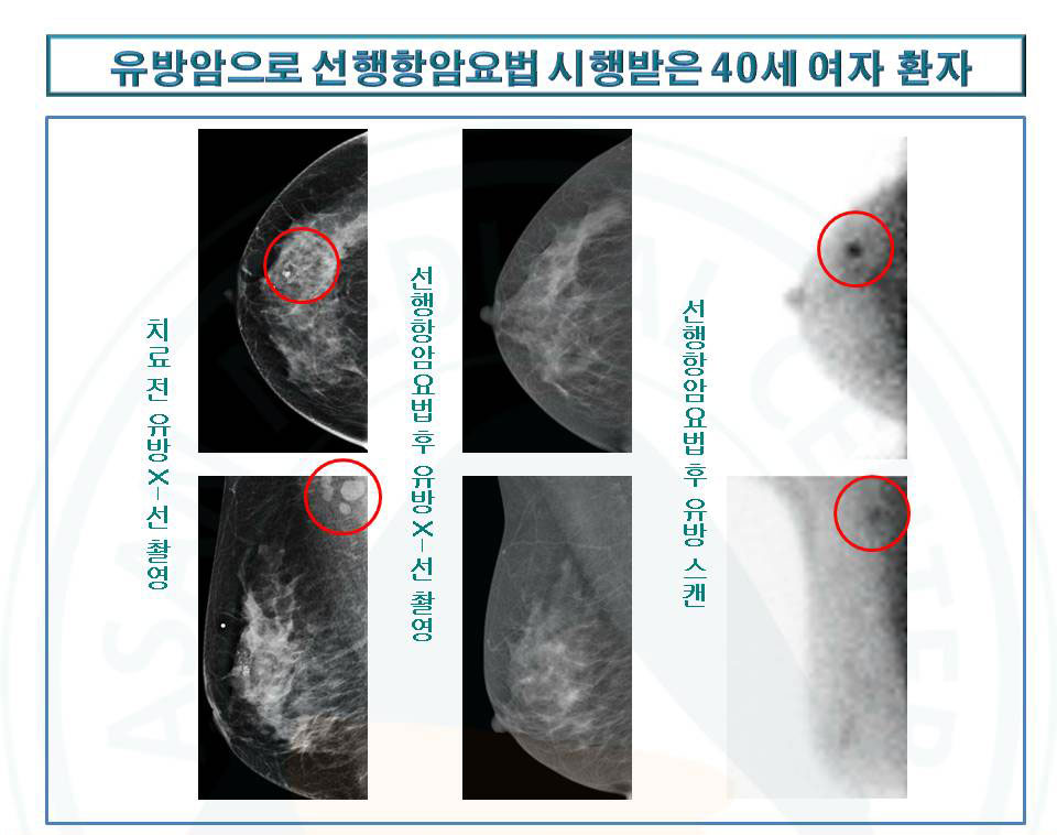 유방암으로 선행항암요법 시행받은40세여자환자의 치료전유방X-선,선행항암요법후 유방X-선찰영과선행항암요법후 유방스켄 사진 예시