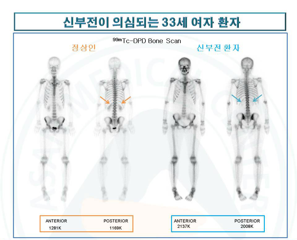 신부전이 의심되는 33세 여자환자의 진료영상 사진예시-만성신부전(골이영양증)을 뼈스캔에서 확인한사례