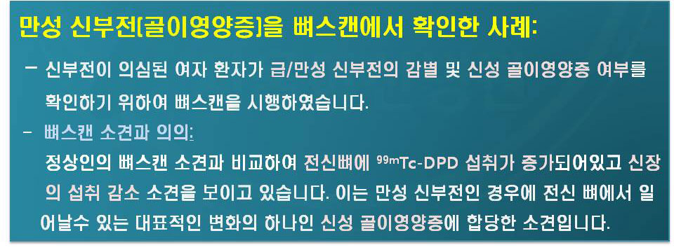 신부전이 의심된 여자환자가 급/만성 신부전의 감별 및 신성 골이영양증 여부를 확인하기 위하여 뼈스캔을 시행하였습니다. -뼈스캔소견과 의의:정상인의 뼈스캔 소견과 비교하여 전신뼈에 99mTc-DPD섭취가 증가되어있고 신장의 섭취 감소 소견을 보이고 있습니다. 이는 만성 신부전인 경우에 전신 뼈에서 일어날수 있는 대표적인 변화의 하나인 신성 골이영양증에 합당한 소견입니다.