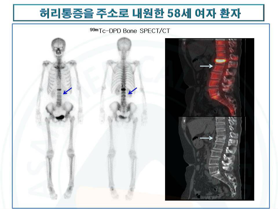 허리통증을 주소로 내원한 58세 여자환자의 진료사진 예시-최근의 압박 골절을 뼈스캔 전신영상및 SPECT/CT에서 확인