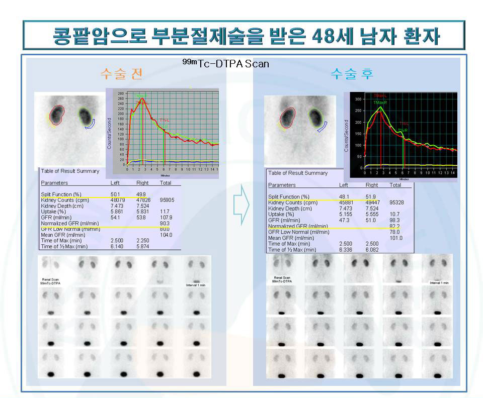 콩팥암으로 부분절제술을 받은 48세 남자환자의 진료영상 사진 예시-콩팥기능 및 사구체여과율(GFR)을 DTPA를 사용한 동적 콩팥 스캔으로 확인