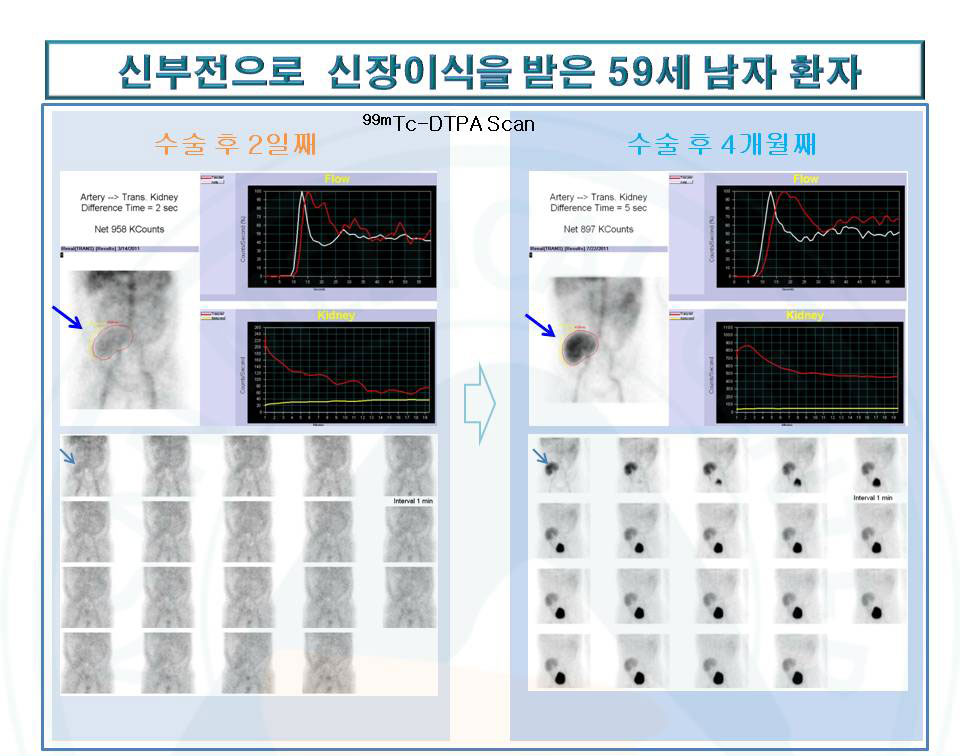 신부전으로 신장이식을 받은 59세남자환자의 진료영상 사진 예시- 이식콩팥의 관류 및 기능을 DTPA동적 콩팥 스캔으로 평가한 사례