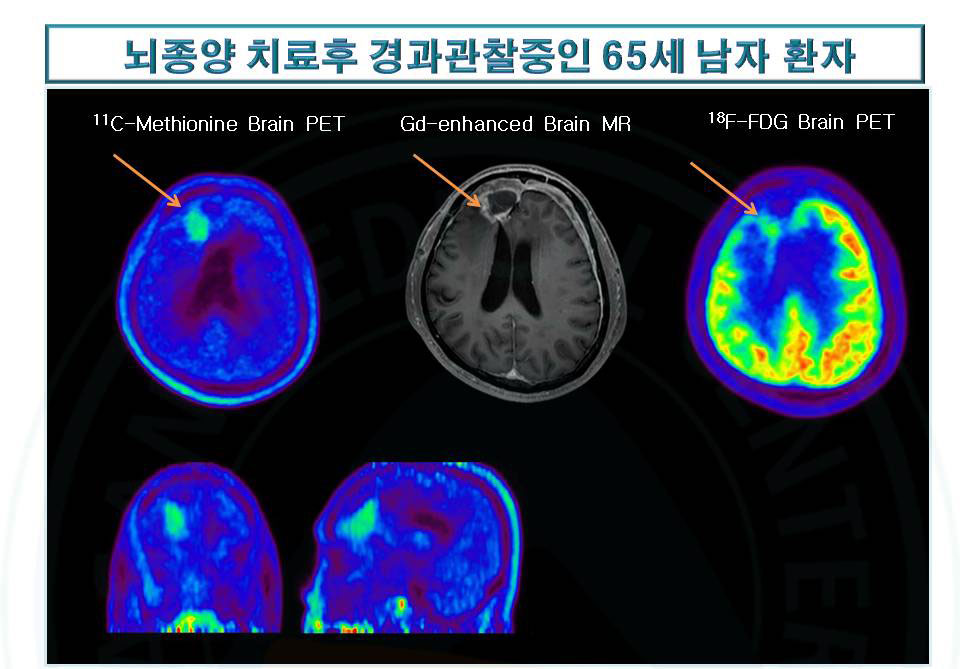 뇌종양 치료후 경과관찰중인 65세 남자환자의 진료사진 예시-뇌종양의 재발을 11C Methionoine PET에서 확인한 사례