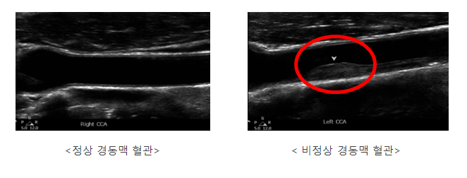 경동맥 초음파를 통해 본 정상 경동맥 혈관 및 비정상 경동맥 혈관 예시