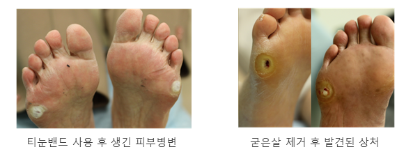 티눈 밴드 사용 후 생긴 피부병변 및 굳은살 제거 후 발견된 상처 예시