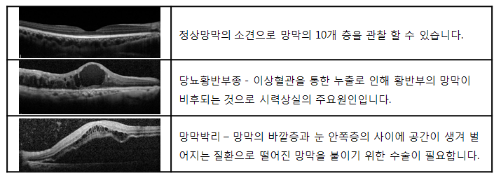 첫번째 사진의 경우 정상망막의 소견으로 망막의 10개층을 관찰할 수 있습니다. 두번째 사진의 경우 당뇨황반부종 - 이상혈관을 통한 누출로 인해 황반부의 망막이 비후되는 것으로 시력상실의 주요원인입니다. 세번째 사진의 경우 망막박리 - 망막의 바깥층과 눈 안쪽층의 사이에 공간이 생겨 벌어지는 질환으로 떨어진 망막을 붙이기 위한 수술이 필요합니다.